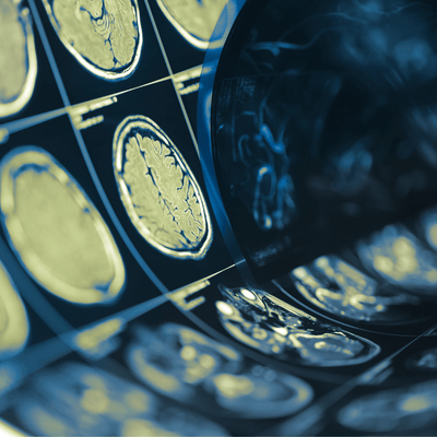 Chronic Traumatic Encephalopathy (CTE): What You Need to Know - Q30