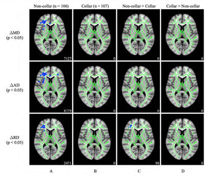 Growing Concern Around the Prevalence of Chronic Traumatic Encephalopathy - Q30